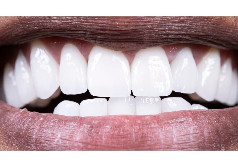 What a Calculus Bridge Looks and Feels Like on Your Teeth. Plus, How to Prevent One