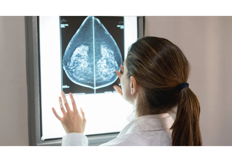 What Is Breast Density, and Why Do You Need to Know Yours?