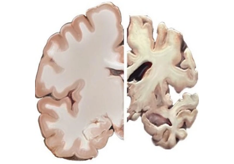 Alzheimerova choroba souvisí i s poruchou činnosti imunitních buněk