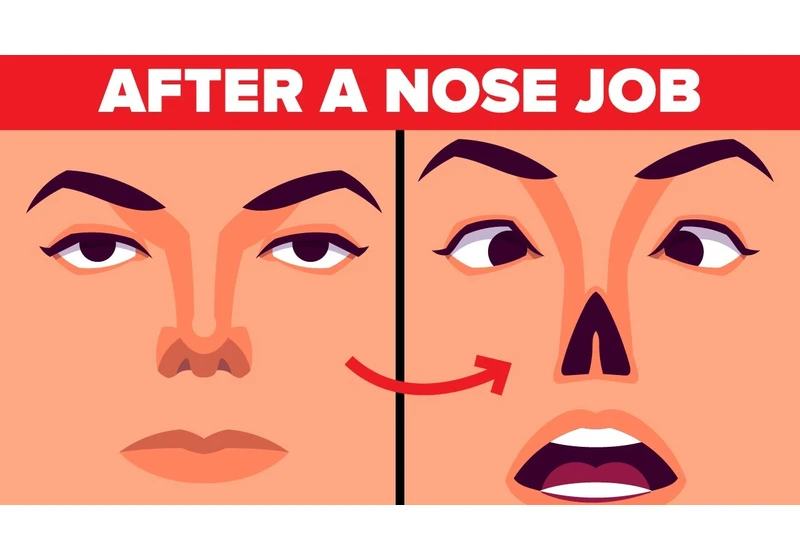 What Happens When You Get a Nose Job?