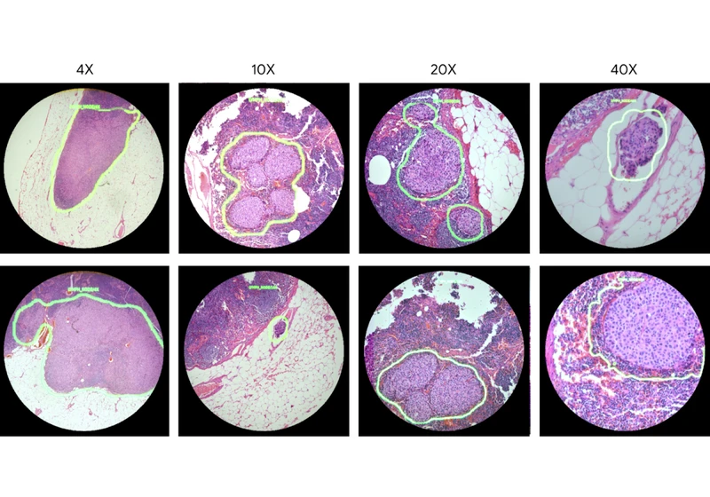 Google is developing an AI-powered microscope to help doctors spot cancer