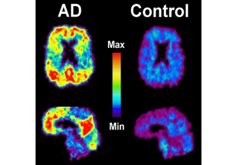 Formaldehyd ako indikátor Alzheimerovej choroby?